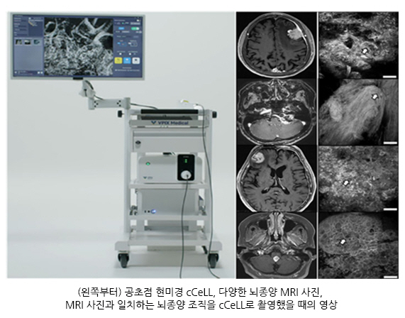 고려대 강신혁 교수팀, cCeLL 통한 '수술 중 실시간 뇌종양 진단' …