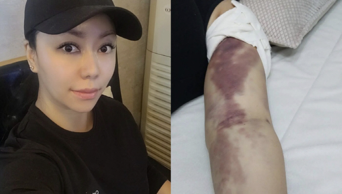 '50억 재력가' 10기 정숙, '피멍'으로 뒤덮여…결국 일정 취소