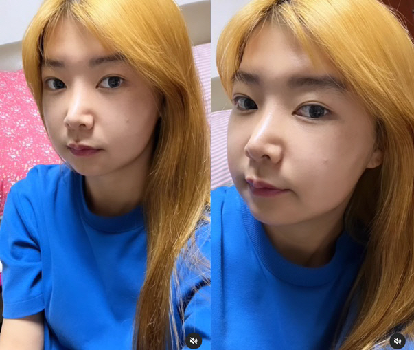 10기 영자, '양악 수술' 후 예뻐진 얼굴 '얼짱 각도도 완벽 소화'