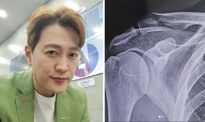 문천식, 빗길 자전거 사고로 '쇄골 박살'→결국 수술
