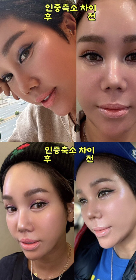 '강원래♥' 김송, 인중 축소 40일차…성형 전후 사진 보며 대만족