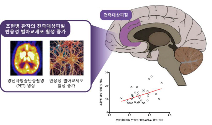 조현병 환자 뇌 '반응성 별아교세포' 활성 증가 최초 확인…치료제 개발 …