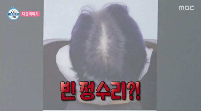 박나래, 40세에 빈정수리 '탈모' 진단에 '눈물'...기안84 "남성형…