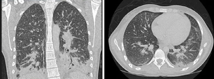 Teenager's lung photo of a one-month e-cigarette 'Shock', like shattered glass