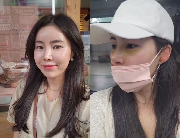 Young-sook, 10th member, even double eyelid nose surgery 'Boo-gi  a lot of bruises '