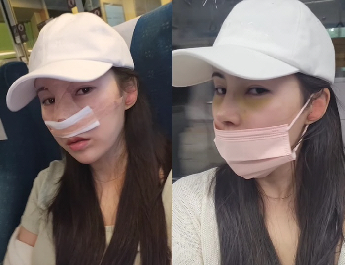 Young-sook, 10th member, even double eyelid nose surgery 'Boo-gi  a lot of bruises '