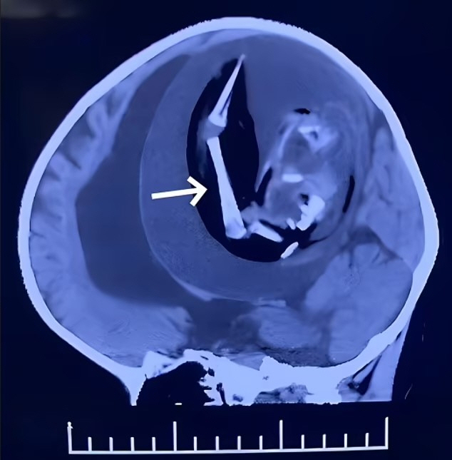 18cm in the skull of a one-year-old child found 'Twin Fetal'