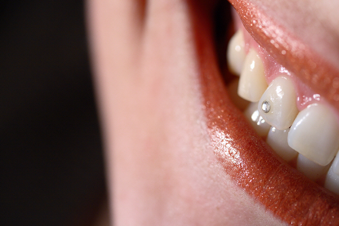 Cubic Attachments to Teeth 'Chiku' Trend, Will It Be Good for Your Health?