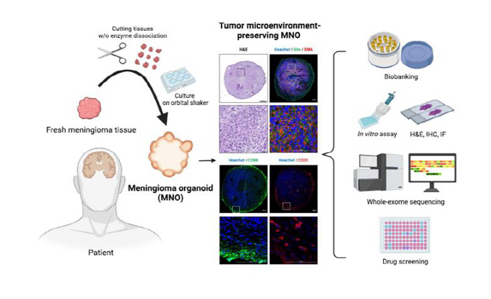 Using Cells for Meningioma Patients 'Organoid', Developed for the First Time in Korea