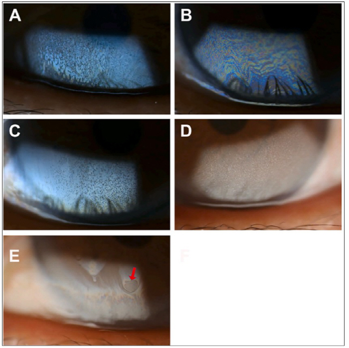 'Cosmetics, tear film lipid layer test results are distorted'…Korea's First Identification