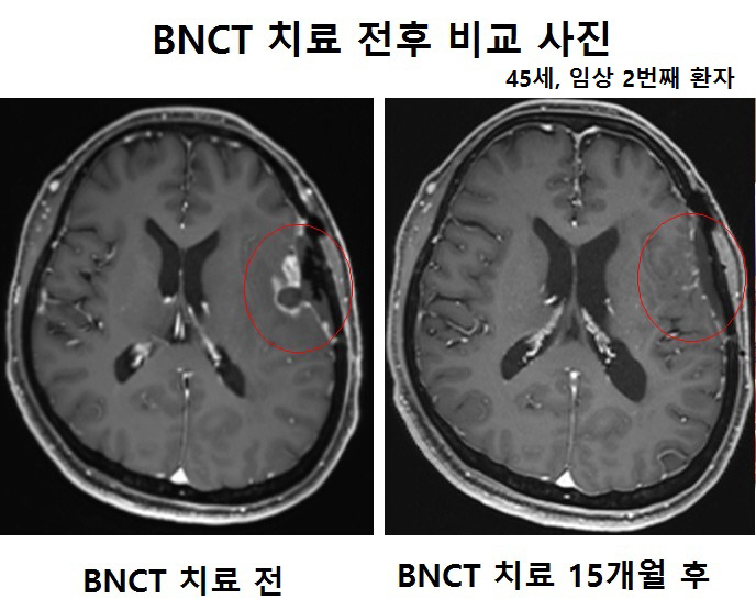 Gachon University Gil Hospital, 'Dream Cancer Treatment Device'A-BNCT phase 1 clinical trial is incomplete