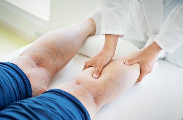 If your legs hurt and you see veins popping out 'lower limb varicose veins'Cautionary increase in summer