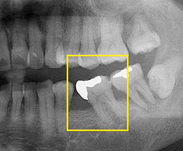 If you don't have teeth, you're wrong. If you leave empty teeth, it can cause complications