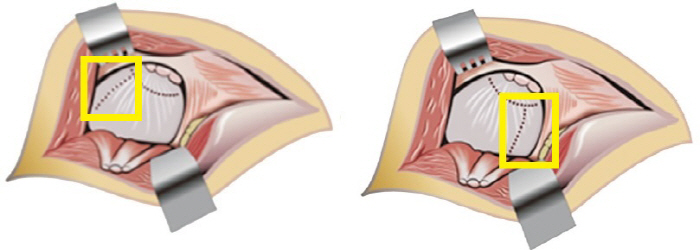 Development of a new artificial hip arthroplasty to prevent postoperative dislocation