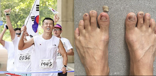 'Jeong Hye-young ♥'Sean, disastrous foot condition with 5 toenails missing'Hwangbokjeol 81.5km challenge'