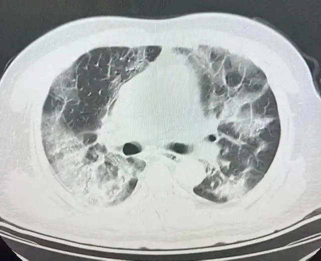 Seven-Year-Old Girl With Sunscreen Turns Lung White in One Day