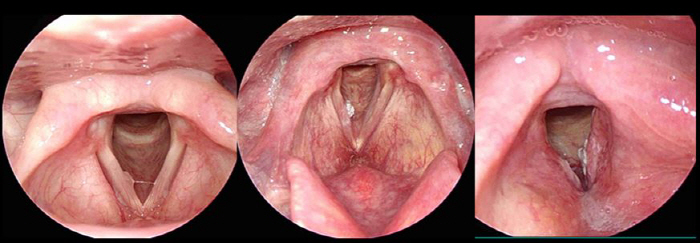  Don't ignore laryngeal cancer when your voice changes for more than 6 weeks