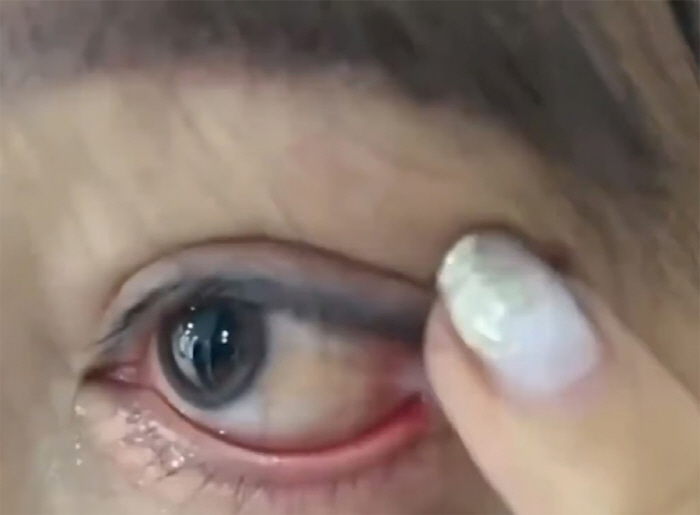 Sew eye and eye corner during double eyelid surgery'Deterioration of vision and hair loss'