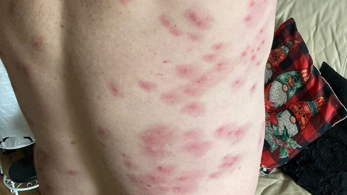 A man stung 240 times by a herd of wasps, miraculous survival'The back was covered with wasps'