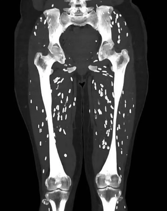 Photograph of a patient with parasitic infection after eating undercooked pork 'Terrible'