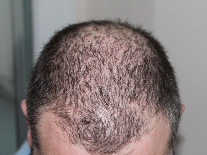 Even if hair loss is not completely cured, it can be delayedWhat are the truths of the six myths?