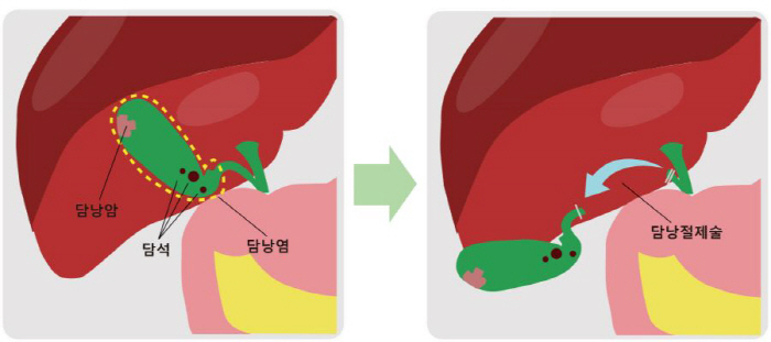 Pain in the solar plexus and right upper abdomen, do you have cholecystitis?Five-year survival rate of gallbladder cancer is only 27%