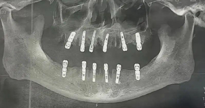 23 teeth pulled out and 12 implants died of a heart attack 13 days later