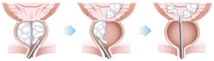 Prostate hypertrophy 'Holep Surgery' proves effective and safe treatment