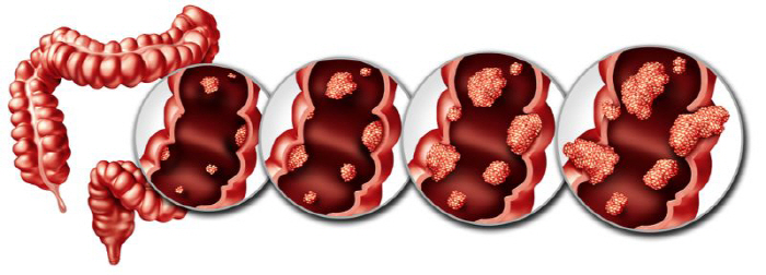 1.7-fold increase in complications of colon cancer surgery during COVID-19 Causes cancer diagnosis and treatment delay