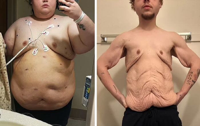 A man who lost 126 kg of weight 