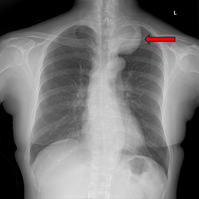 Major organ threat' mediastinal tumors'Early diagnosis is important because survival rate is not high