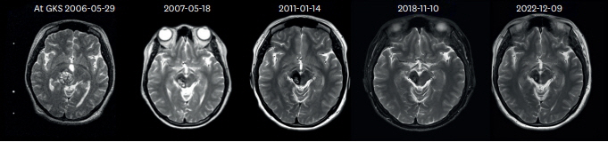 Gamma Knife Surgery Demonstrates Effectiveness in Long-Term Treatment of Hemorrhage in Brain Spanning Hemangioma Drastic Risk