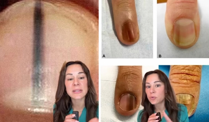 Why Nail and Claw Colors Need to Look Carefully Skin Cancer 'Signs'Possibility