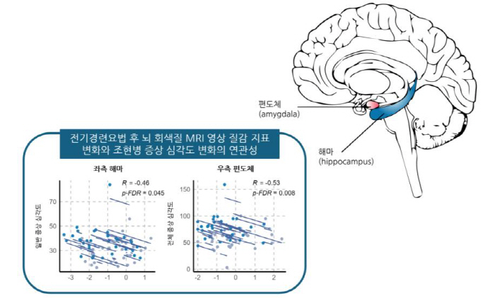 Investigating the association between electrical cramps therapy and treatment-resistant schizophrenia with changes in brain structure