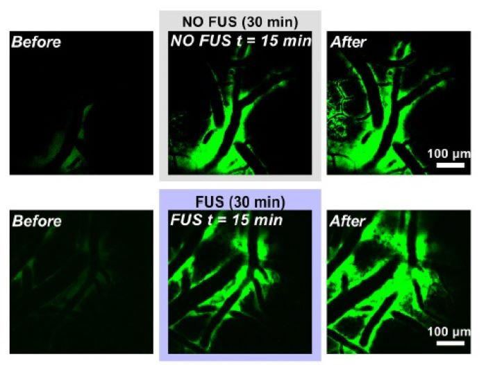 New treatment for dementia opens up and focused ultrasound proves for the first time improvement in circulation of cerebrospinal fluid