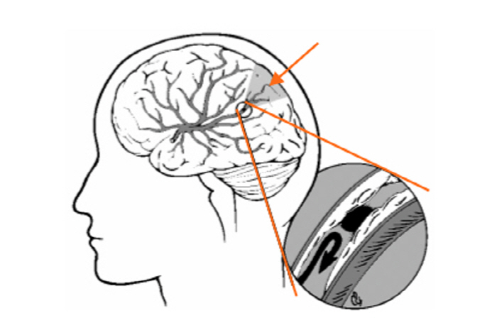 If you don't manage high blood pressure, the Korean Stroke Association presents five prevention methods that risk stroke more than two to four times