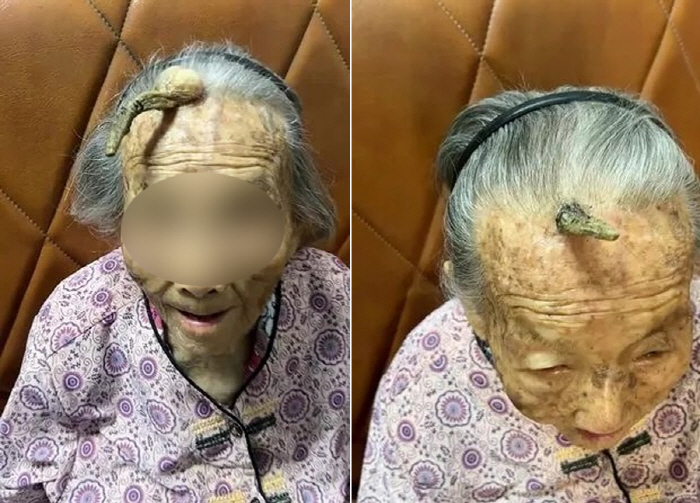 What does a 107-year-old grandmother grow 10cm horns on her hair?