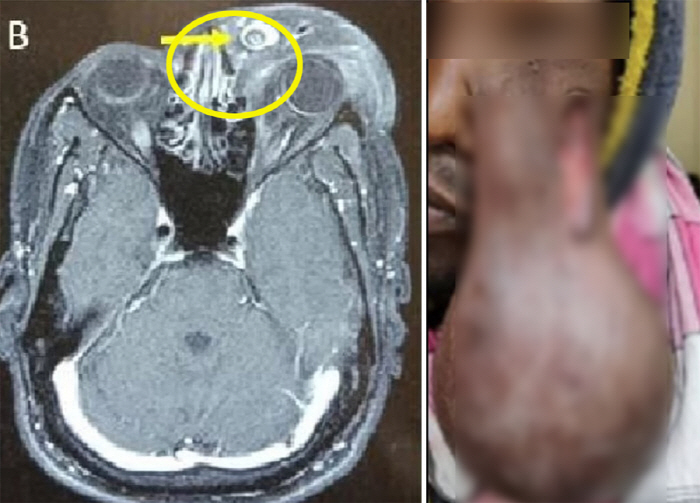 Orange-sized tumour grown in the eyes, infected fungus that extends to the chest 'Shock'