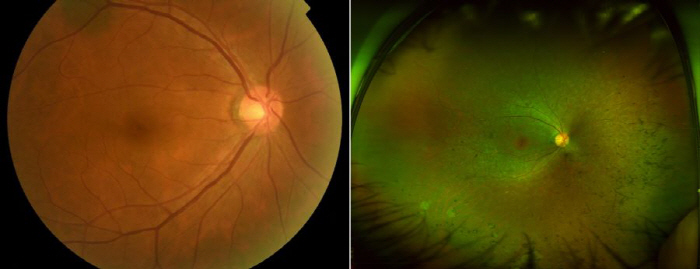 Even teenagers don't feel safe about 'retinal chromatin degeneration' that leads to blindness