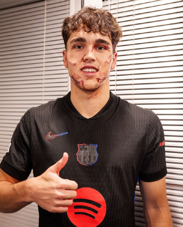 Barca 17-year-old genius, face covered in blood.. Ten stitches in a crazy Soccer Kick → But with a bang 'For Barca!'