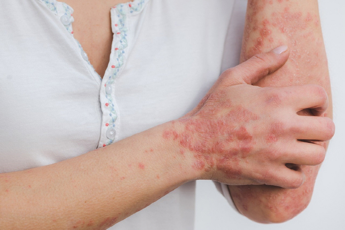 Winter ambush'Psoriasis affects joints and cardiovascular vessels as there are many cases of psoriasis in their 20s