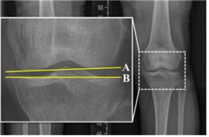 Identify risk factors for knee degenerative arthritis after orthodontic osteotomy