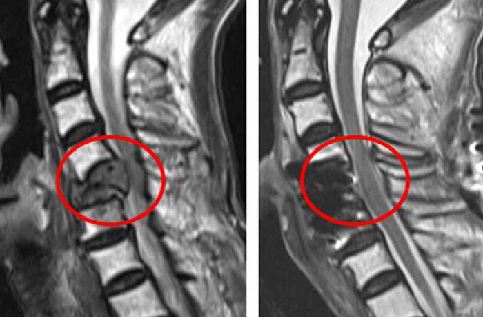 Metastatic Spinal Tumor Patients Need Good Preoperative Nutrition to Lower Complications