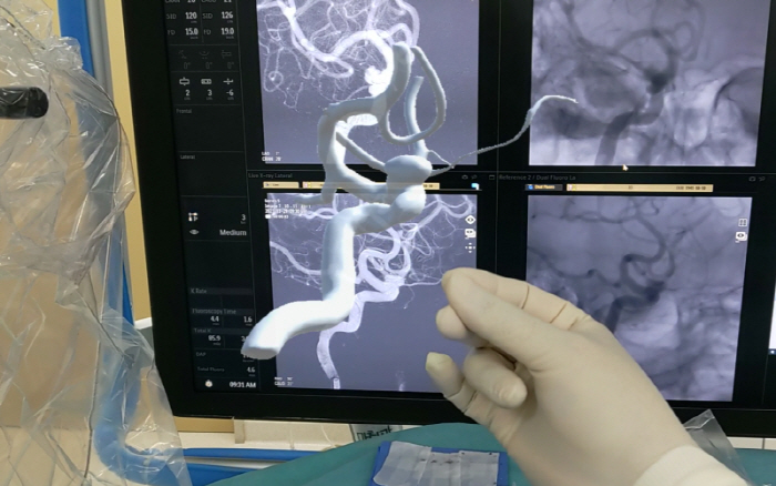 Complex cerebrovascular, 3D, sees it directly in front of your eyes and improves surgical safety