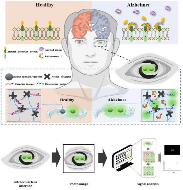 Early diagnosis of Alzheimer's disease through the eyes and development of smartphone-based analysis technology