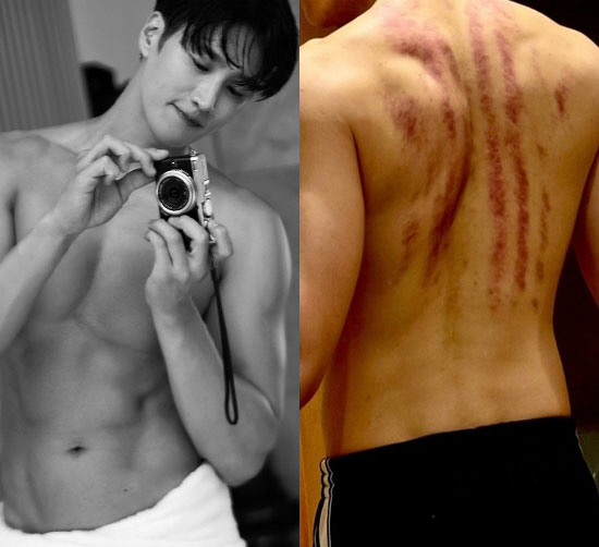 Ahn Bo-hyun, who scratched it with his fingernails...a sharp scar on the back