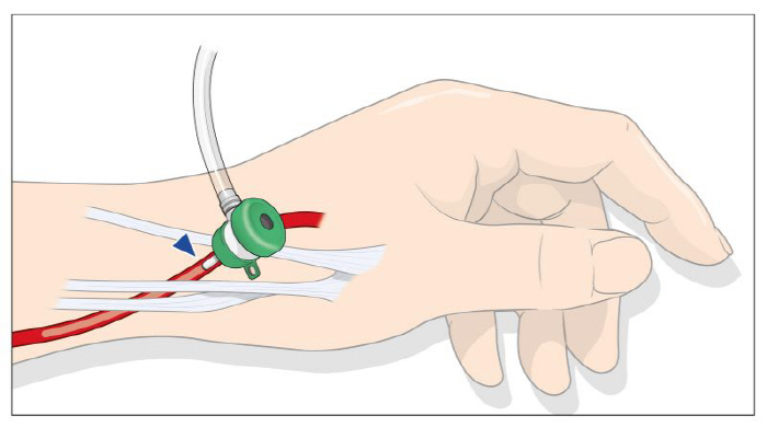 Demonstrate stability in minimally incised cardiovascular procedures in high-risk bleeding groups