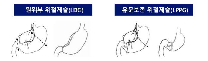 Laparoscopic pylorus preservation gastrectomy to investigate the effectiveness and safety of early gastric cancer treatment