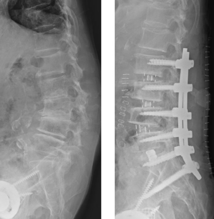 Verifying the safety of spinal surgery over 80 years old There is no difference in complications compared to those in their 60s and 70s