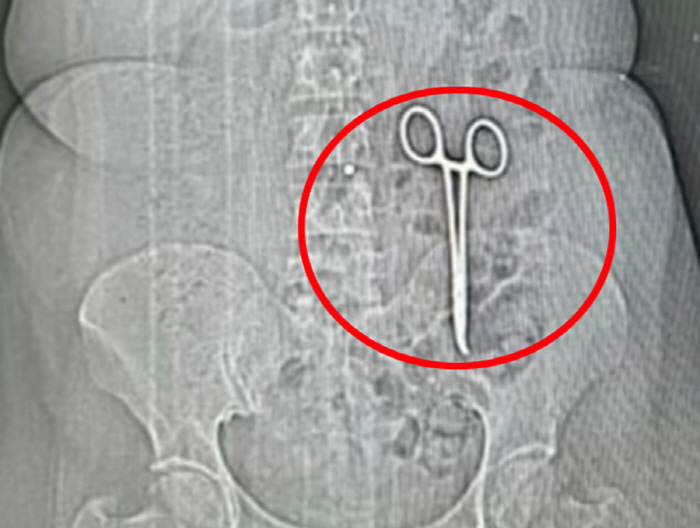 Abdominal pain, scissor found in stomach for 2 years after cancer surgery